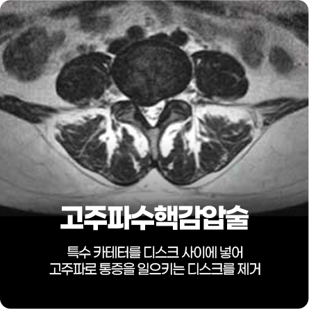 고주파수핵감압술